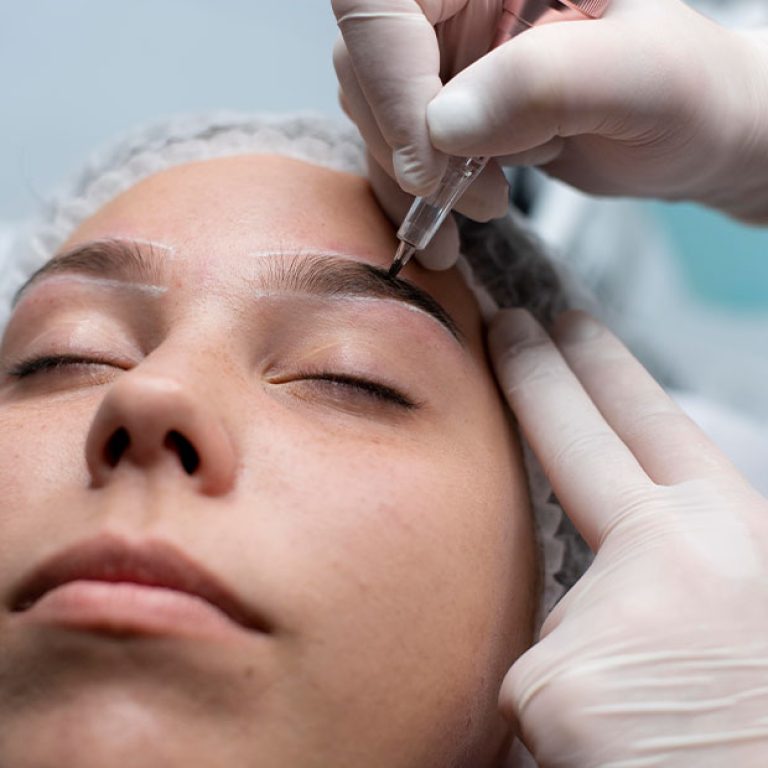 Microneedling)